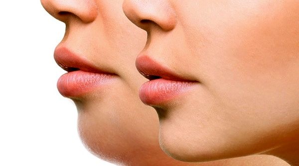 از بین بردن غبغب