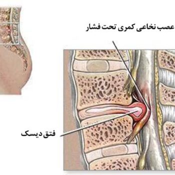 درمان دیسک کمر