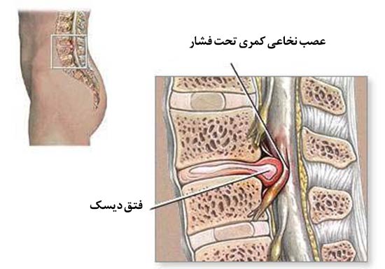 درمان دیسک کمر